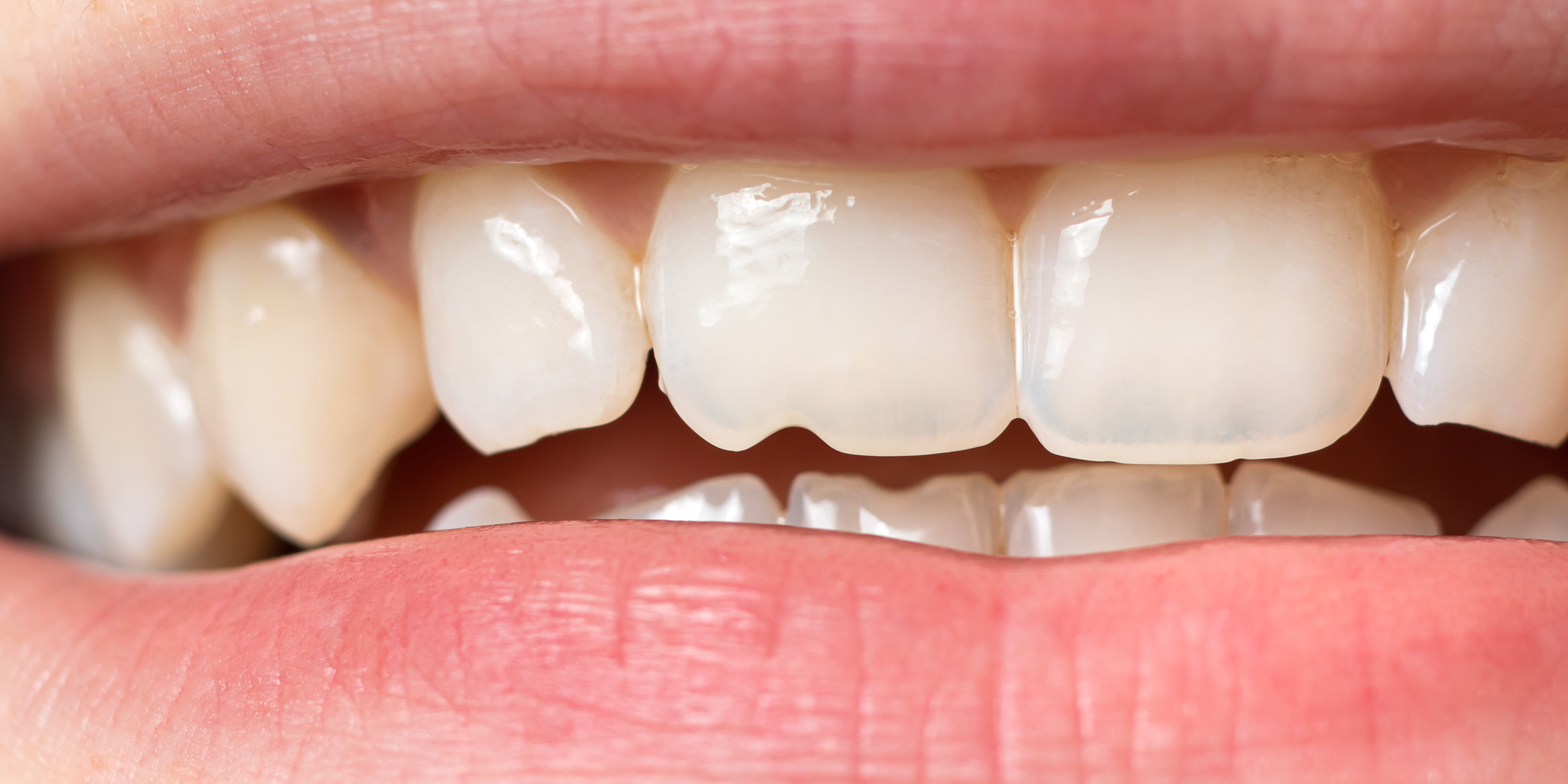 A person's teeth | Source: Shutterstock